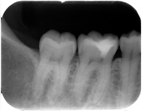 生活歯髄療法