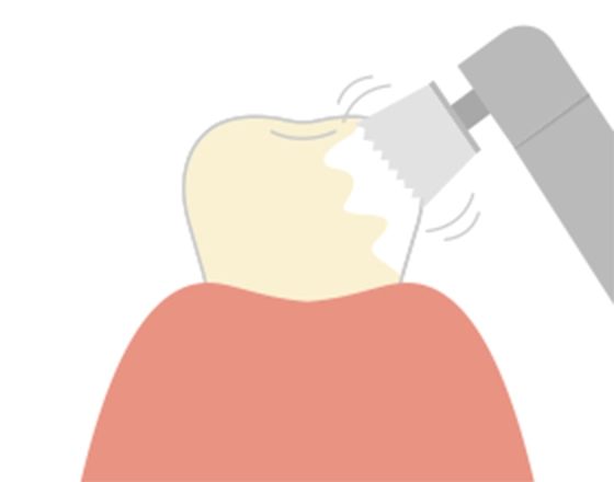 PMTC（Professional Mechanical Tooth Cleaning）